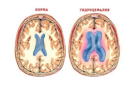 Перевозка больного с гидроцефалией 